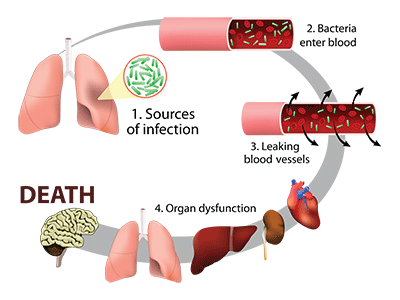 sepsis